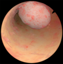 hysteroscopy polyp uterine polyps seen simbionix yaplr nasl